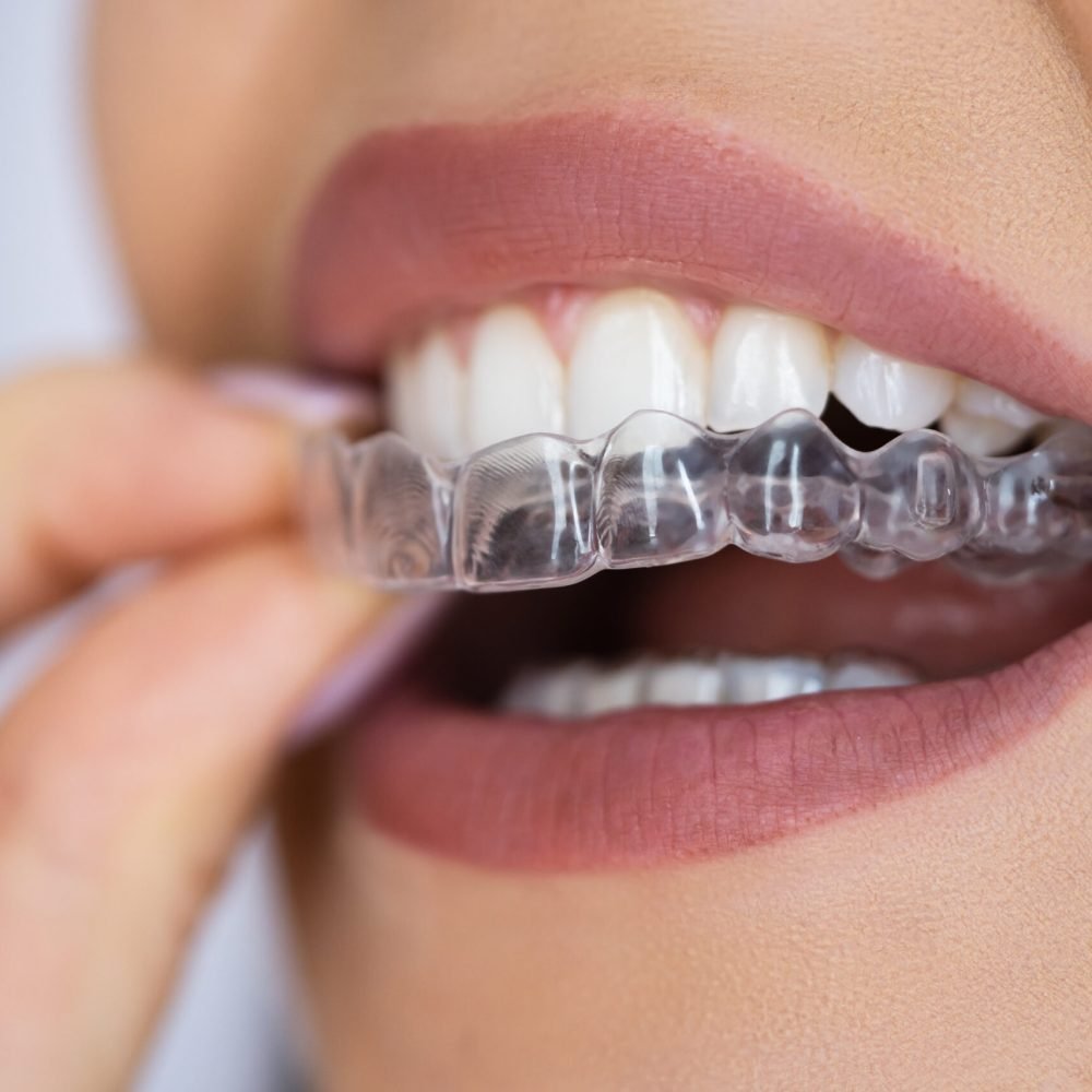 invisalign Casablanca prix